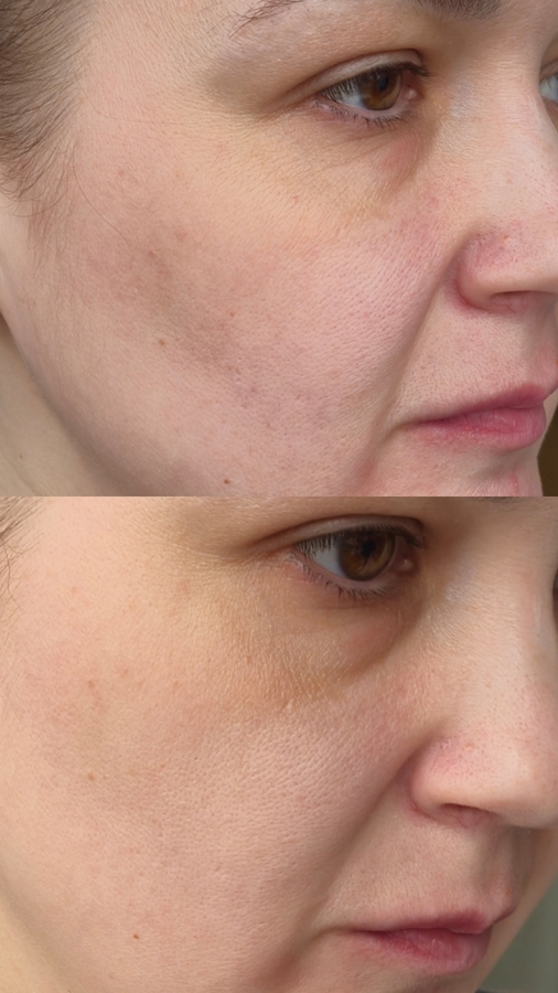 Здесь пудра нанесена только на уход,без тональника.