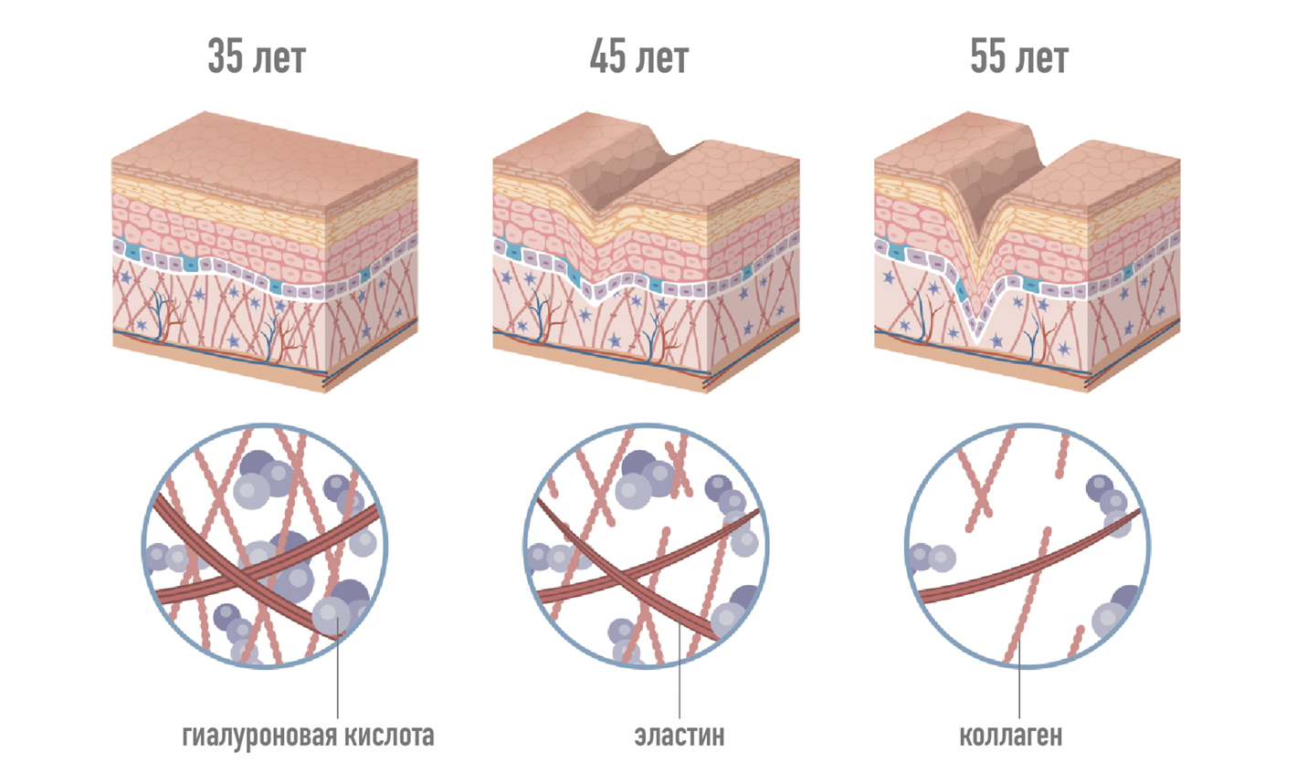 Схема старения кожи: уменьшение гиалуроновой кислоты, эластина и коллагена с возрастом. Разница в 35, 45 и 55 лет.